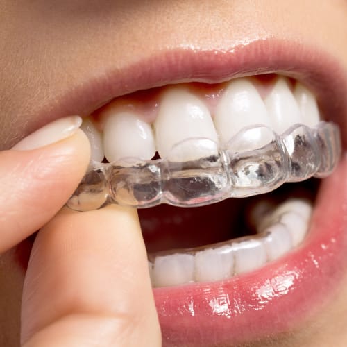 Clear Invisalign aligner being fitted over the upper teeth